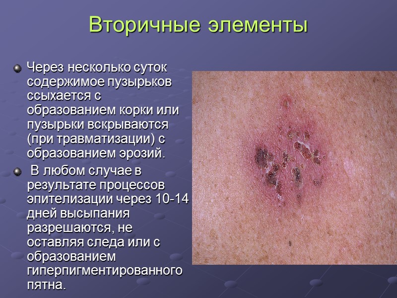 Вторичные элементы  Через несколько суток содержимое пузырьков ссыхается с образованием корки или пузырьки